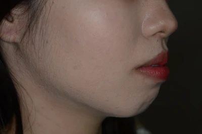 口ゴボ（口元の突出）の矯正治療前の歯並び（治療例）