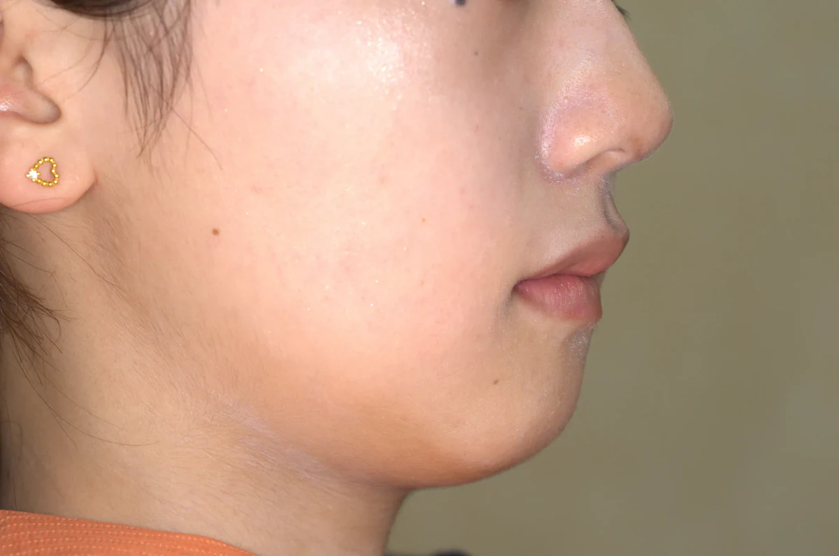 口ゴボ（口元の突出）の矯正治療後の歯並び（治療例）