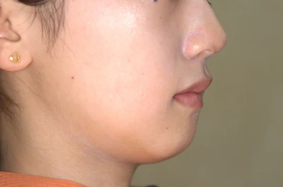 口ゴボ（口元の突出）の矯正治療後の歯並び（治療例）