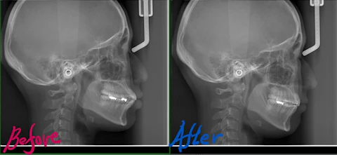 矯正前後の比較