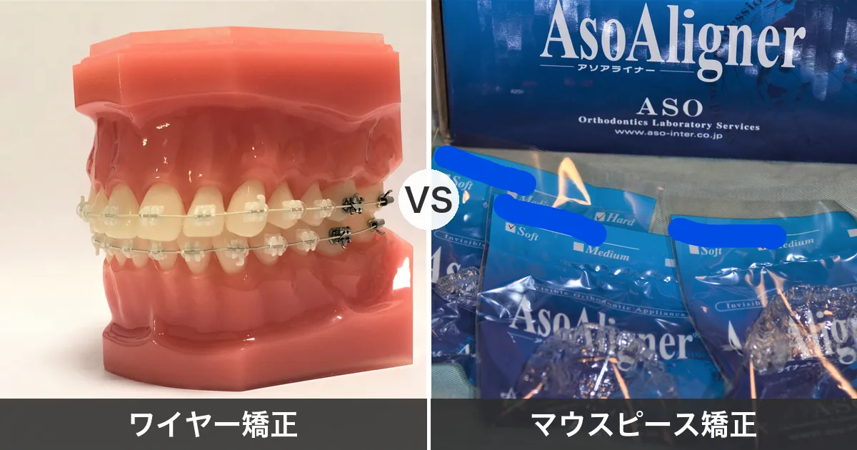 ワイヤー矯正とマウスピース矯正の比較