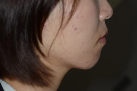 矯正前