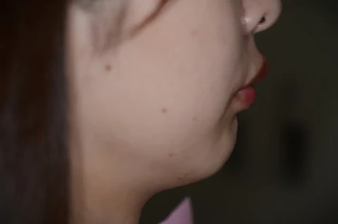 矯正後