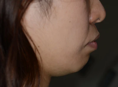 口ゴボ（口元の突出）の矯正治療前の歯並び（治療例）