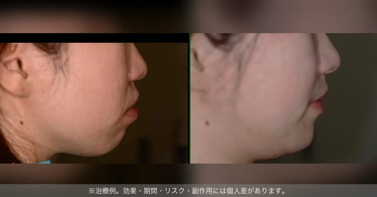 Eライン改善の横顔ビフォーアフター（治療例）