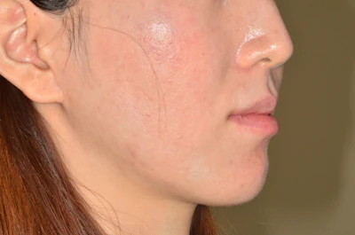 口ゴボ（口元の突出）の矯正治療後の歯並び（治療例）