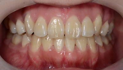 八重歯の矯正治療後の歯並び（治療例）