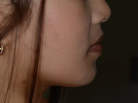 矯正後