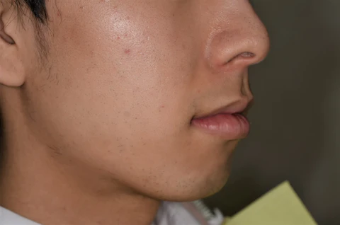 矯正前