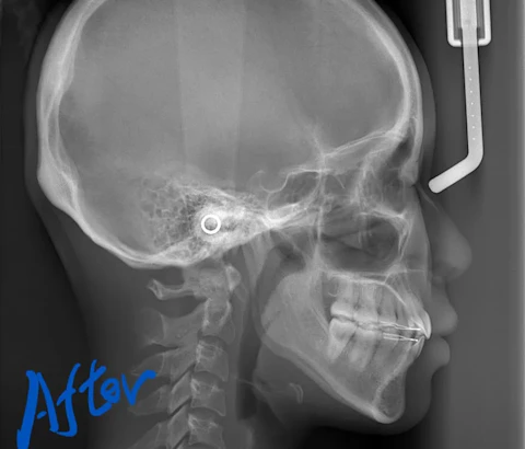 レントゲン（側面）