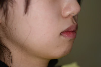 口ゴボ（口元の突出）の矯正治療前の歯並び（治療例）
