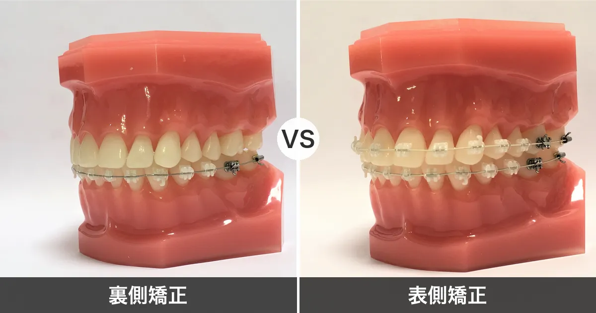 裏側矯正と表側矯正の比較