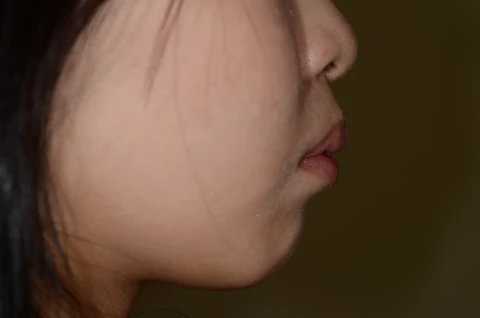 矯正前
