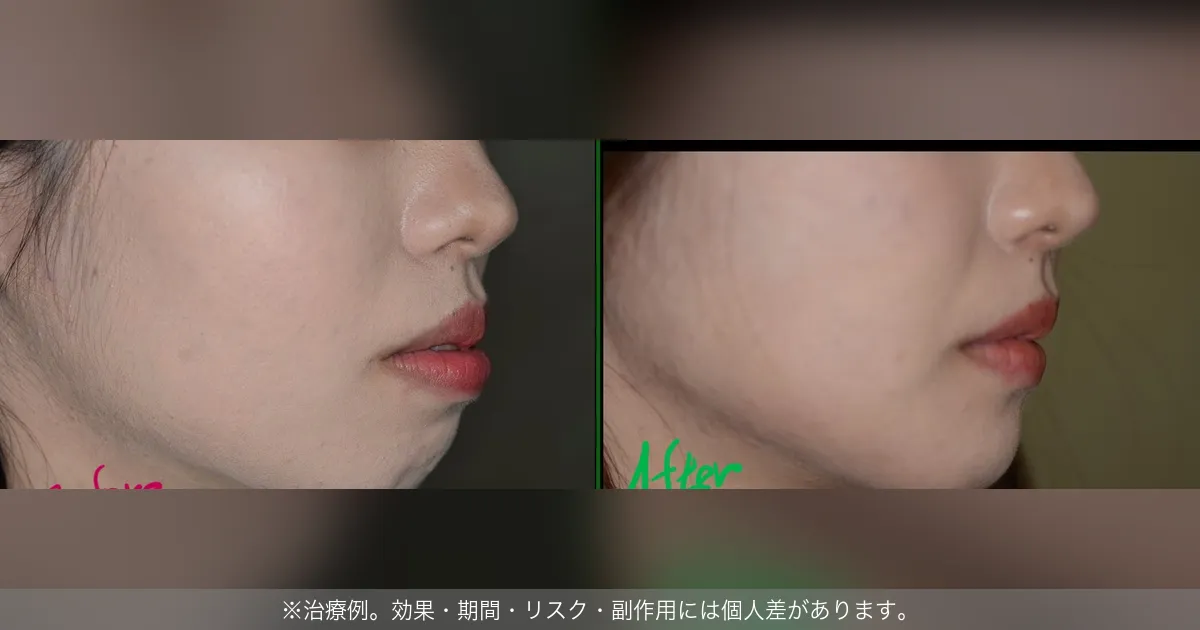 口ゴボ治療の横顔ビフォーアフター（治療例）