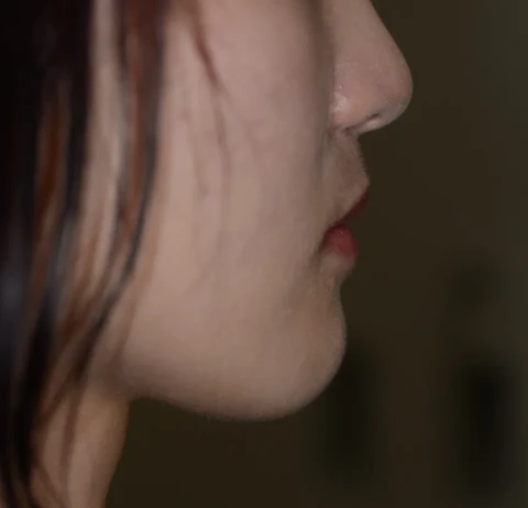 矯正後