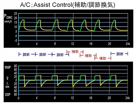 Assist Control