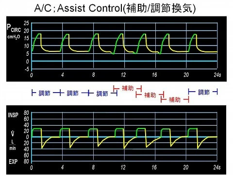 Assist Control