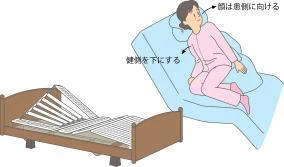片麻痺がある患者さんのポジショニング