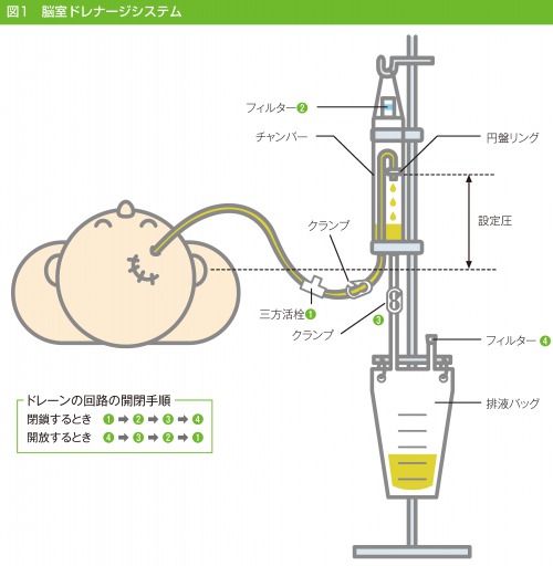 脳室ドレナージシステム