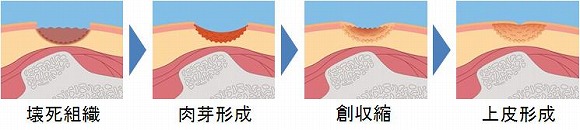 深い褥瘡の治癒過程