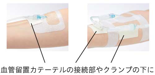 サージカルテープの貼り方例