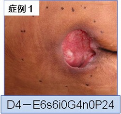 褥瘡治療 症例