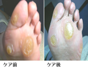 胼胝のケア前後