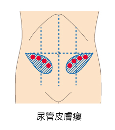 尿管皮膚瘻