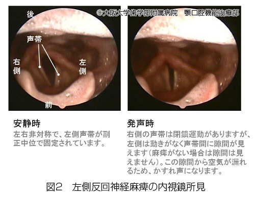 左側反回神経麻痺の内視鏡所見実物写真