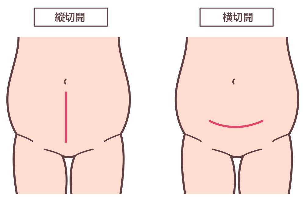 帝王切開の切開方法