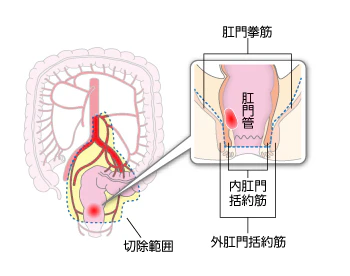 括約筋間直腸切除術
