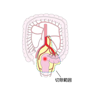 前方切除術