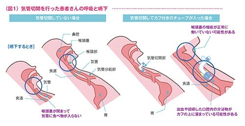 気管切開術を行った患者さんの呼吸と嚥下の図