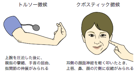 テタニーの確認方法