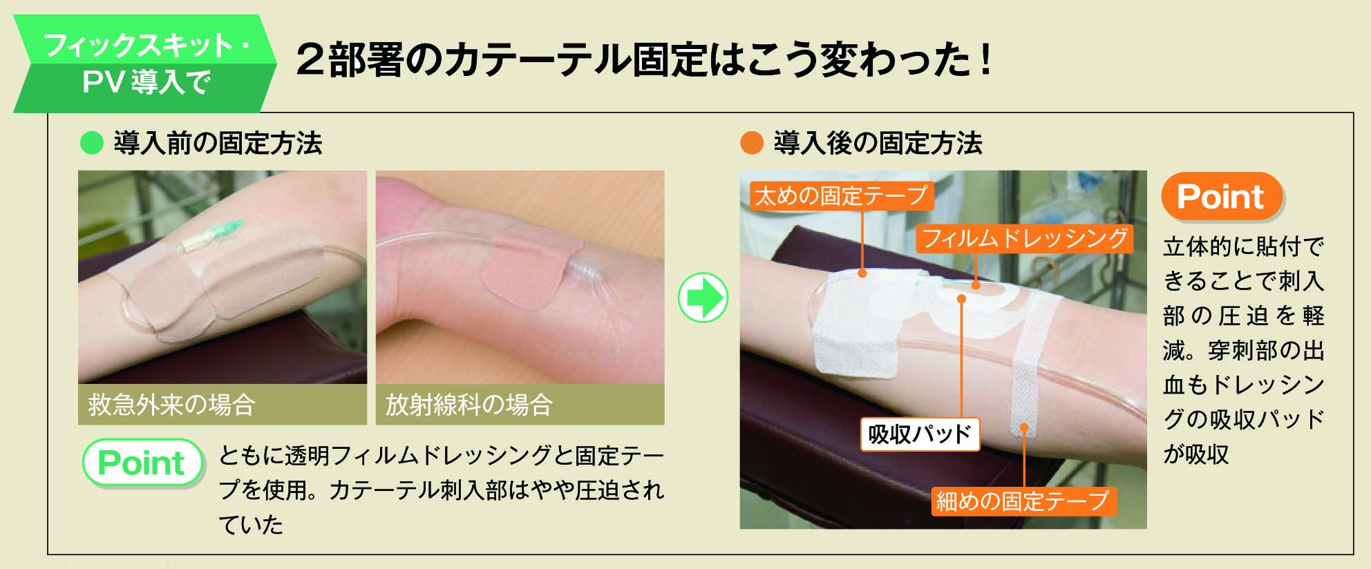 カテーテルの固定の仕方の変化