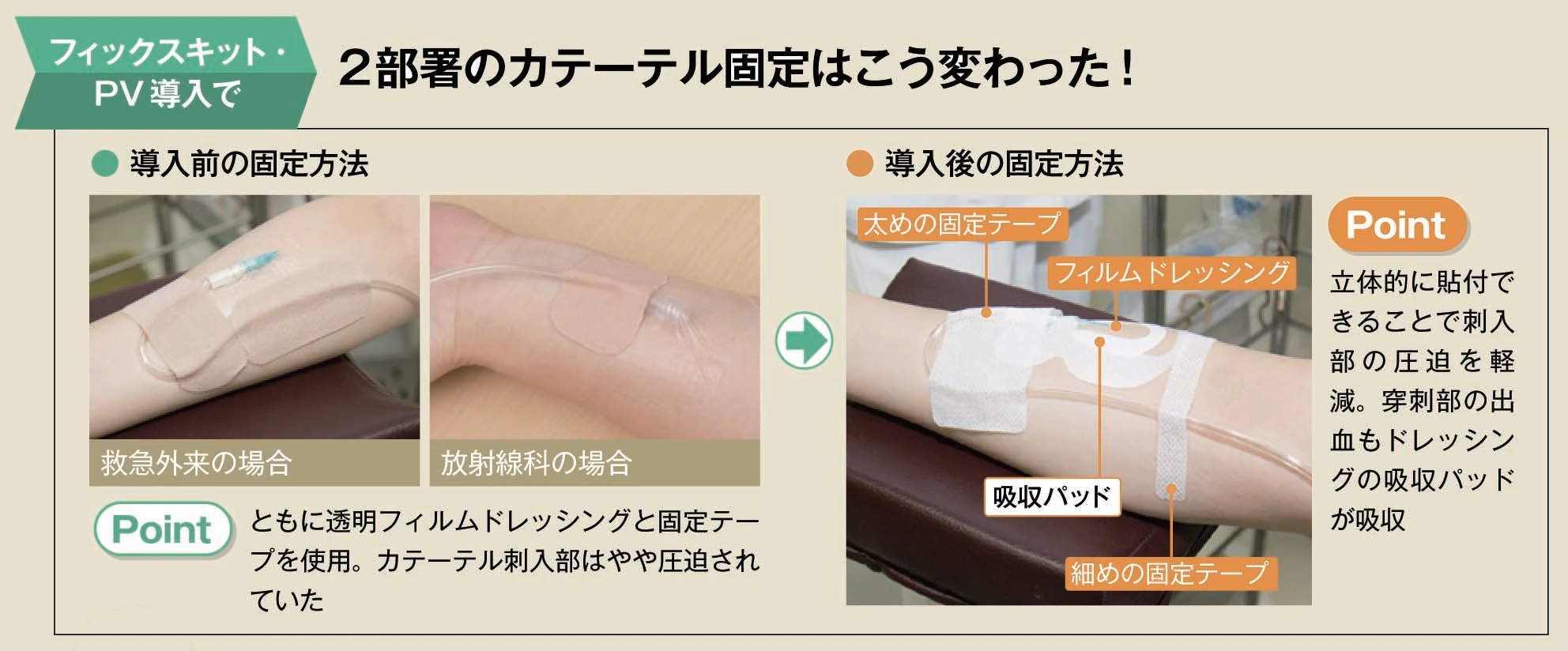 カテーテルの固定の仕方の変化