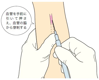逃げやすい血管への穿刺