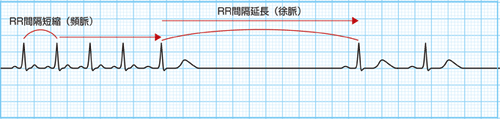 Ⅲ群「徐脈頻脈症候群」