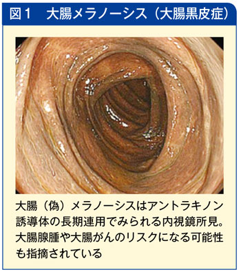 大腸メラノーシス
