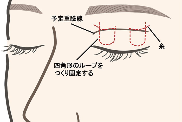 埋没法