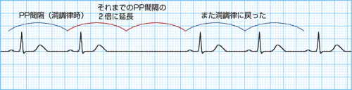 P波が一定のリズムで現れず、PP間隔が延長する洞房ブロック