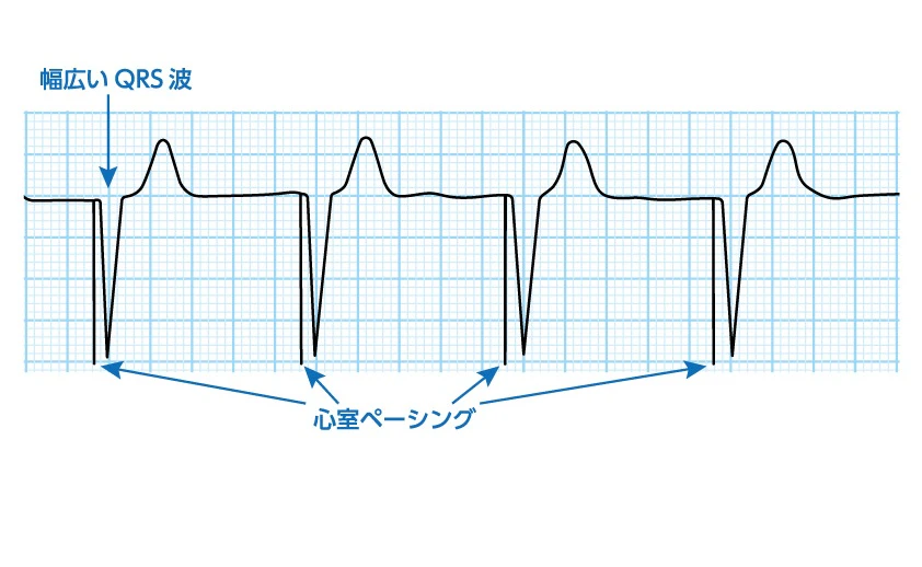 ペーシング波形のイメージ