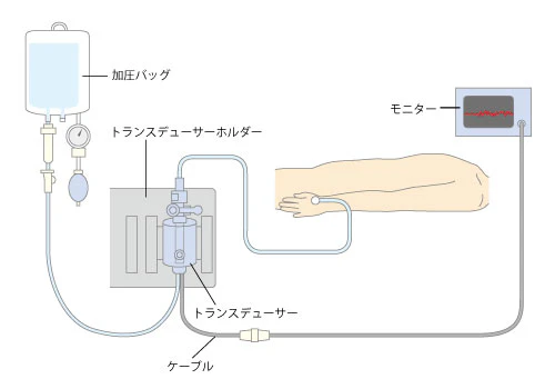Aライン