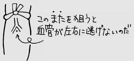 点滴で血管が逃げるときは、Yの字にわかれた血管の股