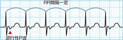 房室リエントリー性頻拍(AVRT)の波形