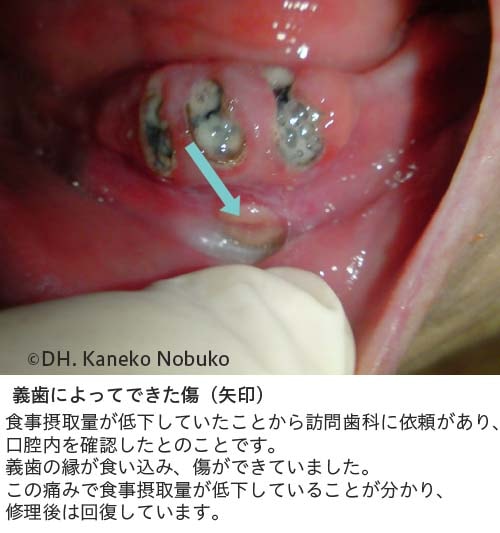 義歯によってできた傷、実際の写真