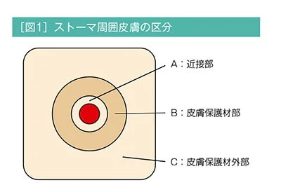 ストーマ周囲皮膚の区分図