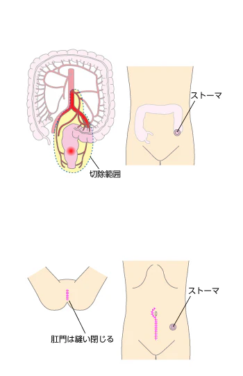 直腸切断術(マイルズ術)