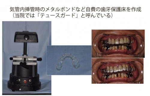気管内挿管時のメタルボンドなど自費の歯牙保護床を作成、実際の写真