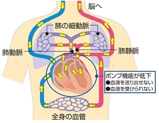 心原性ショックの仕組み説明図